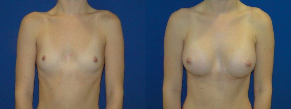 Breast Augmentation Before & After Gallery - Patient 74823008 - Image 1