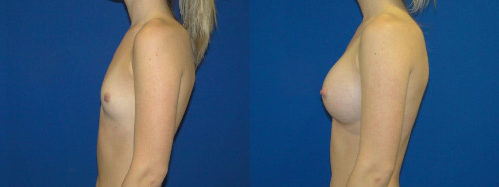 Breast Augmentation Before & After Gallery - Patient 74823008 - Image 2
