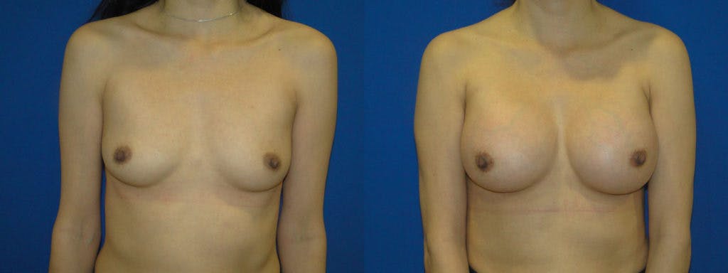 Breast Augmentation Before & After Gallery - Patient 74823009 - Image 1