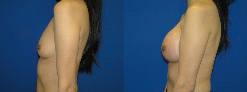 Breast Augmentation Before & After Gallery - Patient 74823009 - Image 2