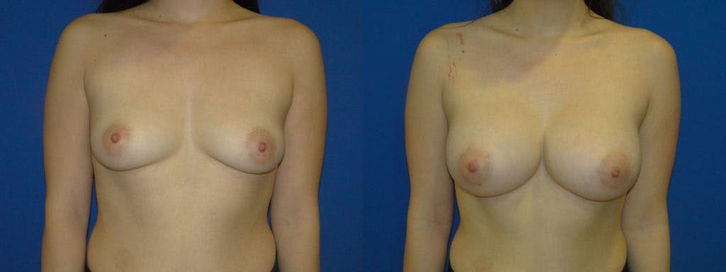Breast Augmentation Before & After Gallery - Patient 74823010 - Image 1