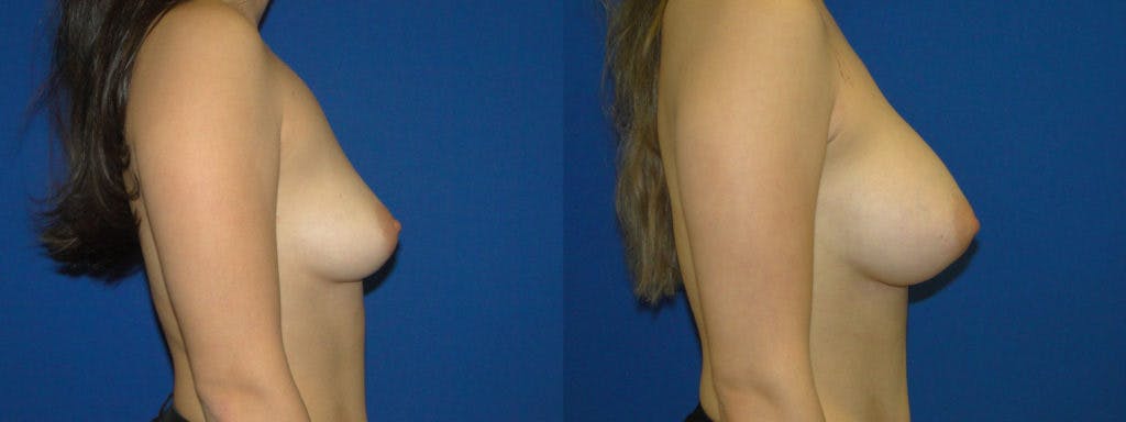 Breast Augmentation Before & After Gallery - Patient 74823010 - Image 2