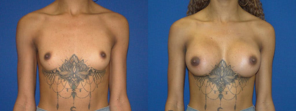 Breast Augmentation Before & After Gallery - Patient 74823011 - Image 1
