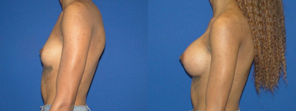 Breast Augmentation Before & After Gallery - Patient 74823011 - Image 2