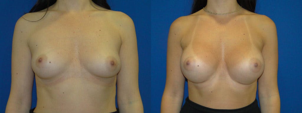 Breast Augmentation Before & After Gallery - Patient 74823012 - Image 1