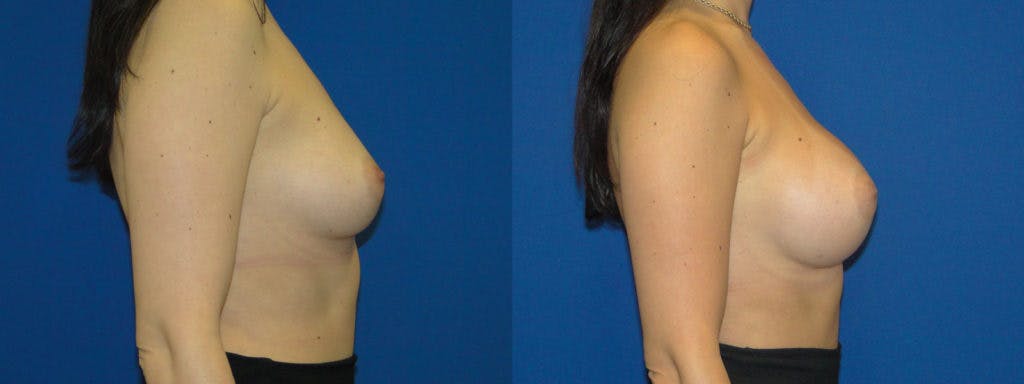 Breast Augmentation Before & After Gallery - Patient 74823012 - Image 2