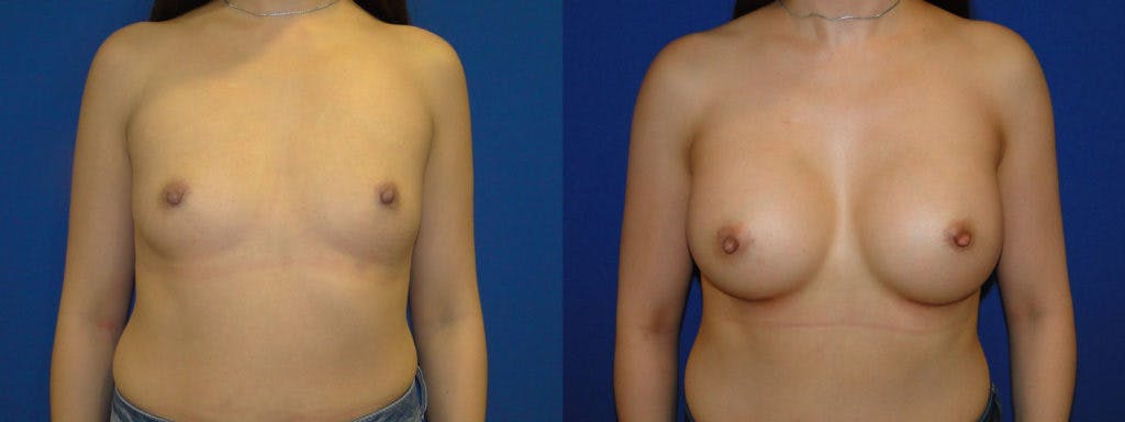 Breast Augmentation Before & After Gallery - Patient 74823013 - Image 1