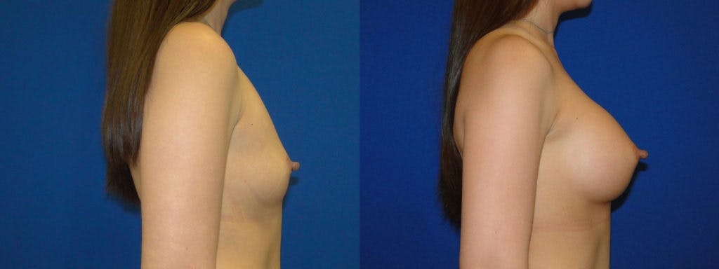 Breast Augmentation Before & After Gallery - Patient 74823013 - Image 2