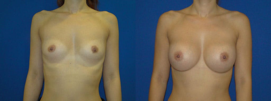 Breast Augmentation Before & After Gallery - Patient 74823014 - Image 1