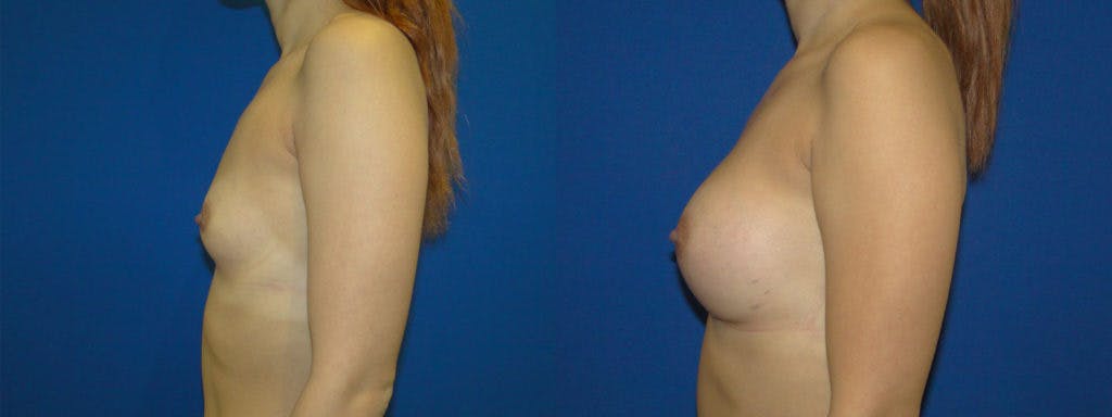 Breast Augmentation Before & After Gallery - Patient 74823014 - Image 2