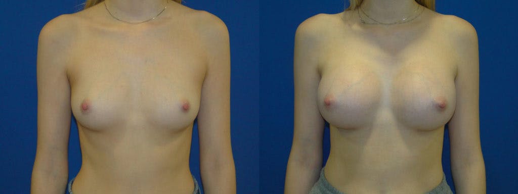Breast Augmentation Before & After Gallery - Patient 74823015 - Image 1