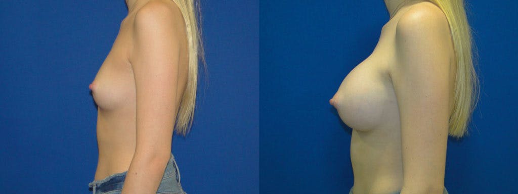 Breast Augmentation Before & After Gallery - Patient 74823015 - Image 2