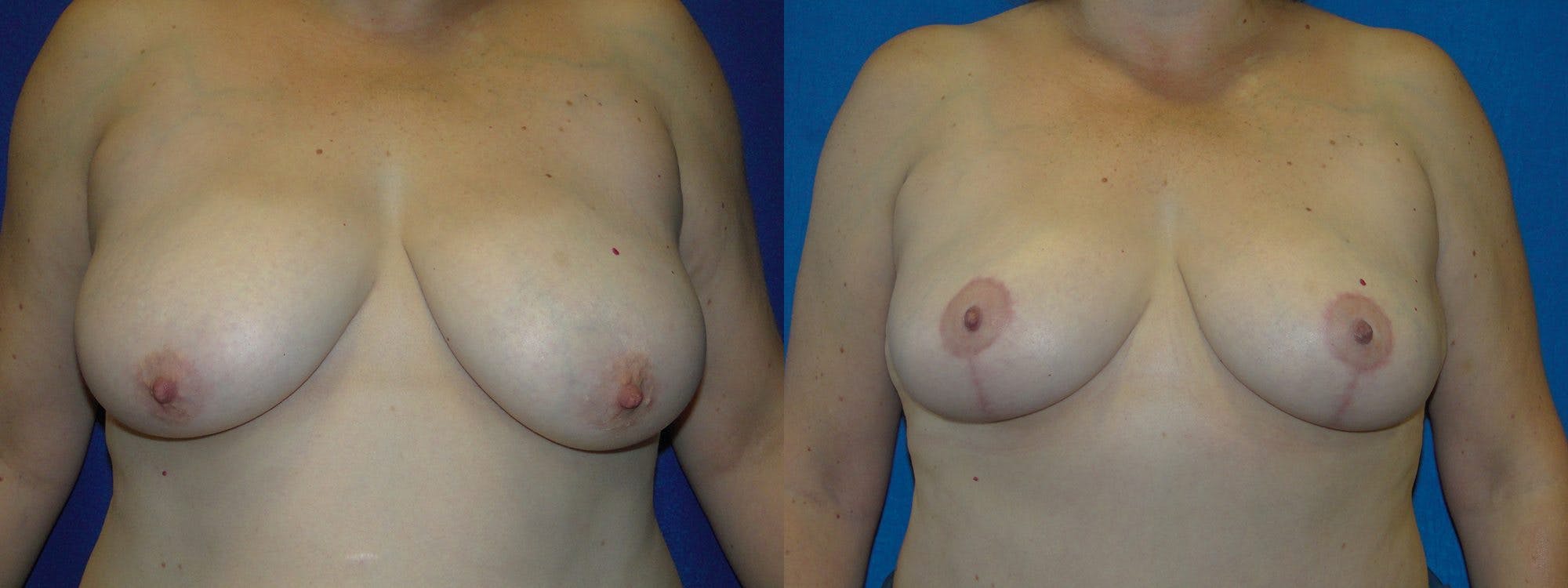 Breast Reduction Before & After Gallery - Patient 74827264 - Image 1