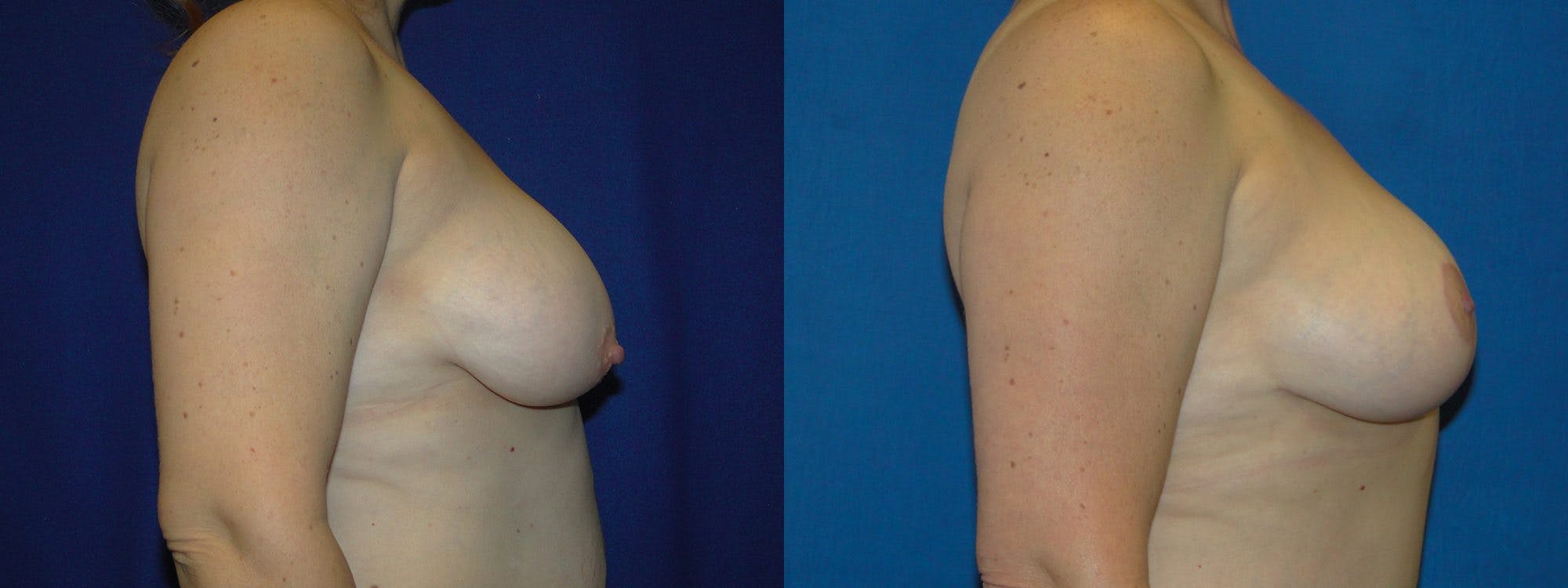 Breast Reduction Before & After Gallery - Patient 74827264 - Image 2