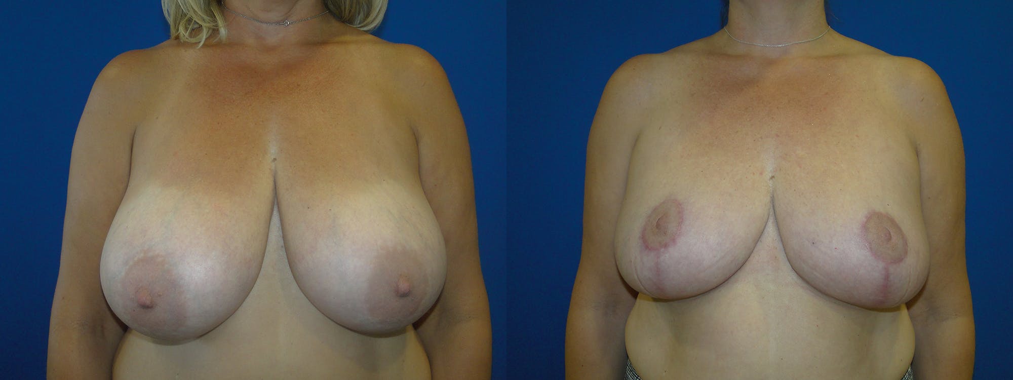 Breast Reduction Before & After Gallery - Patient 74827265 - Image 1