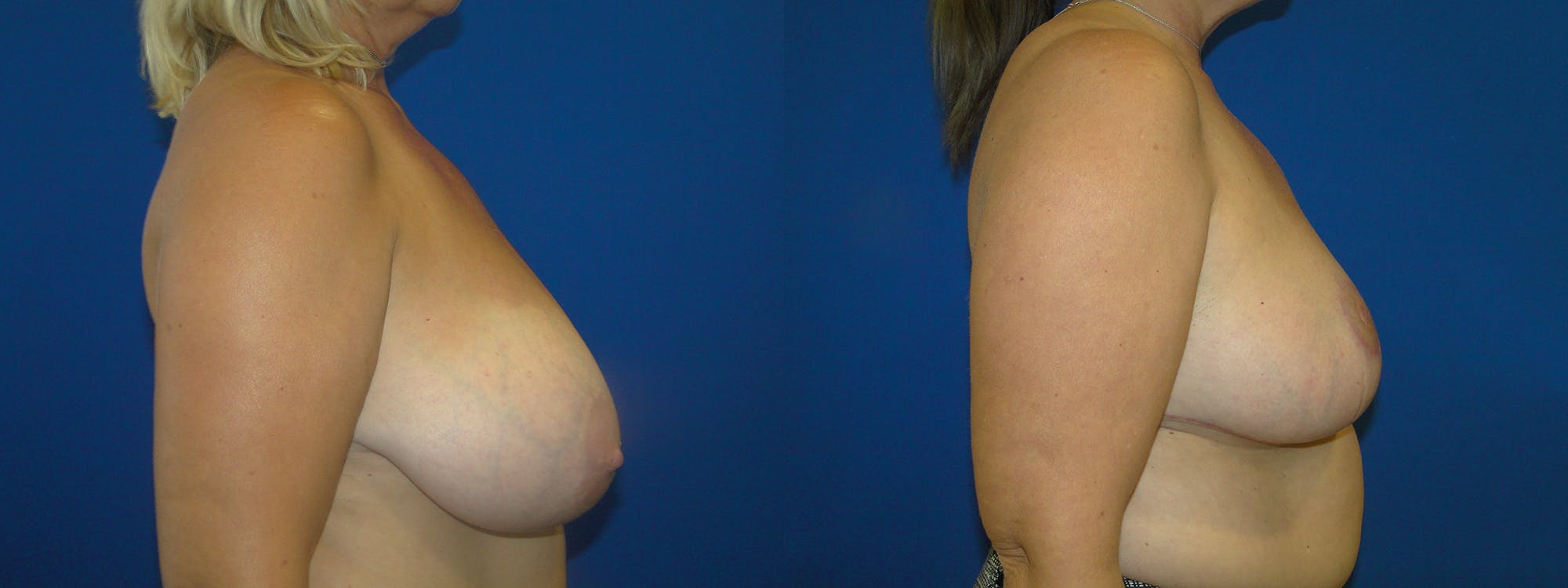 Breast Reduction Before & After Gallery - Patient 74827265 - Image 2