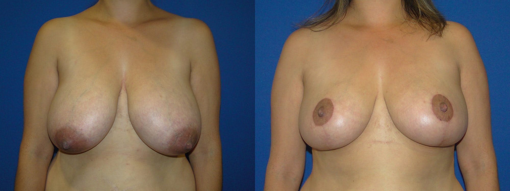 Breast Reduction Before & After Gallery - Patient 74827266 - Image 1
