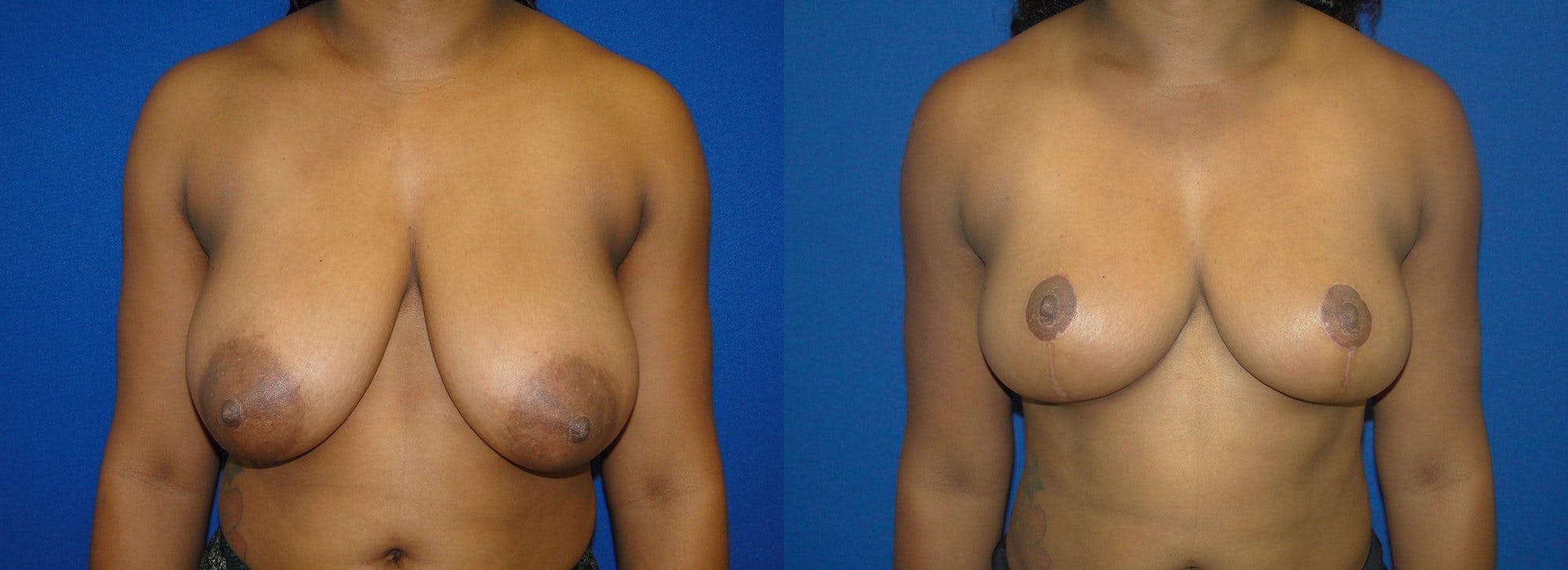 Breast Reduction Before & After Gallery - Patient 74827267 - Image 1