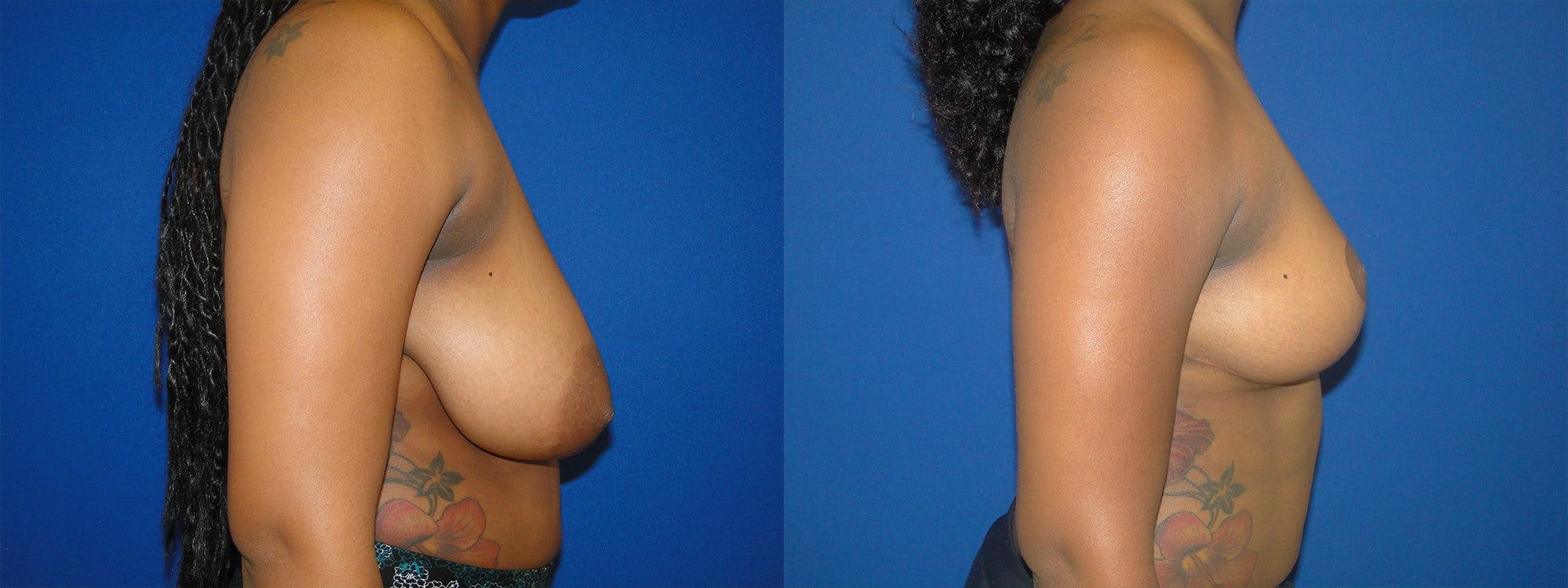 Breast Reduction Before & After Gallery - Patient 74827267 - Image 2