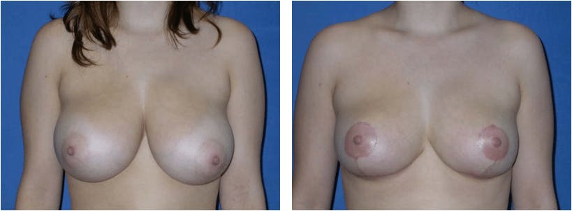 Breast Reduction Before & After Gallery - Patient 74827268 - Image 1