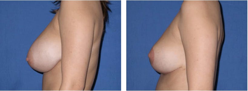 Breast Reduction Before & After Gallery - Patient 74827268 - Image 2