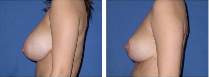 Breast Reduction Before & After Gallery - Patient 74827268 - Image 2