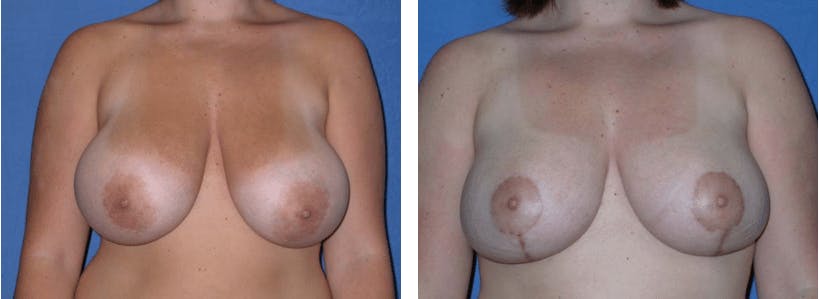 Breast Reduction Before & After Gallery - Patient 74827269 - Image 1