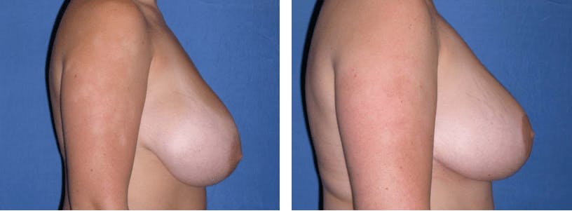 Breast Reduction Before & After Gallery - Patient 74827269 - Image 2