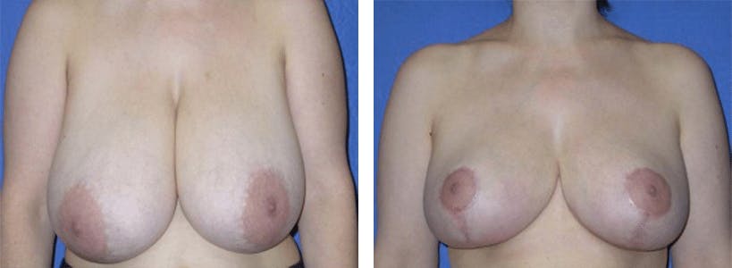 Breast Reduction Before & After Gallery - Patient 74827270 - Image 1