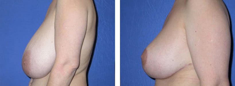 Breast Reduction Before & After Gallery - Patient 74827270 - Image 2