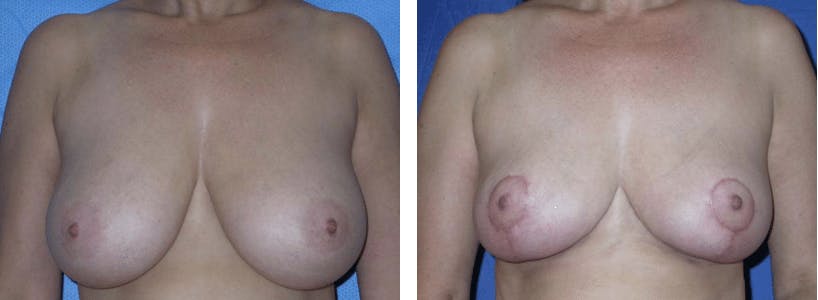 Breast Reduction Before & After Gallery - Patient 74827271 - Image 1