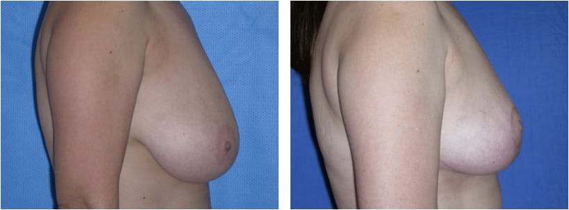 Breast Reduction Before & After Gallery - Patient 74827271 - Image 2