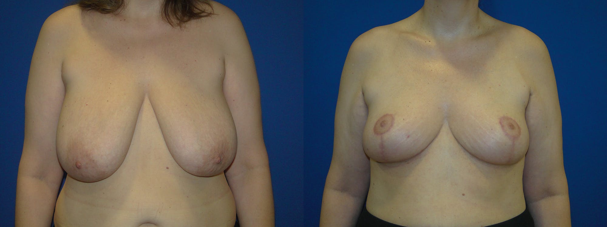 Breast Reduction Gallery - Patient 74827272 - Image 1