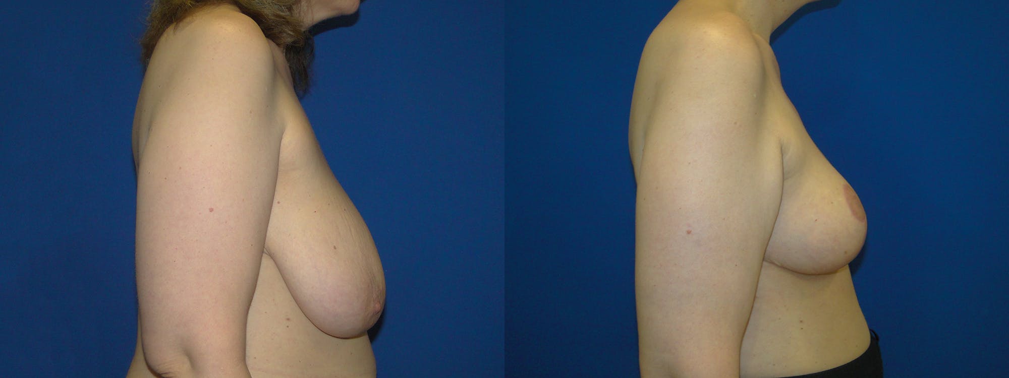 Breast Reduction Before & After Gallery - Patient 74827272 - Image 2