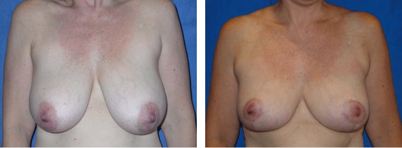 Breast Reduction Before & After Gallery - Patient 74827273 - Image 1