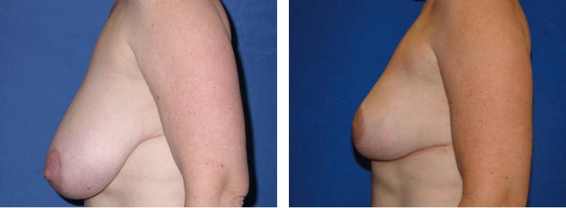 Breast Reduction Before & After Gallery - Patient 74827273 - Image 2