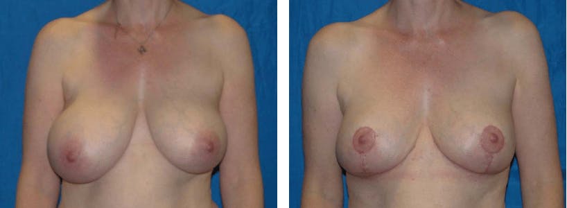 Breast Reduction Before & After Gallery - Patient 74827274 - Image 1