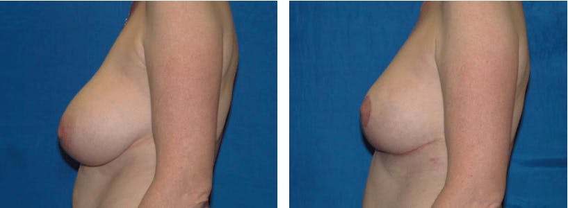 Breast Reduction Before & After Gallery - Patient 74827274 - Image 2