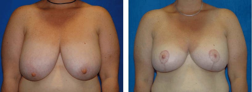 Breast Reduction Before & After Gallery - Patient 74827275 - Image 1