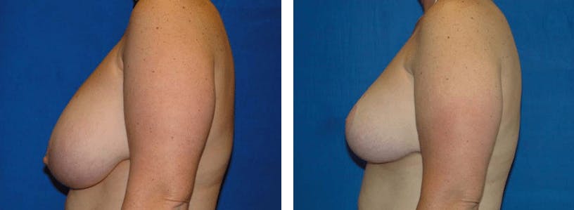 Breast Reduction Before & After Gallery - Patient 74827275 - Image 2