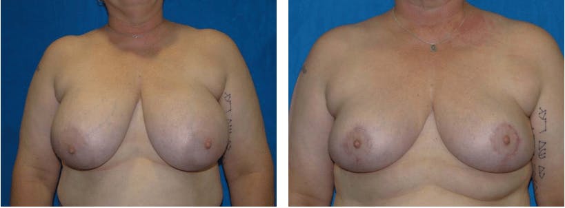 Breast Reduction Before & After Gallery - Patient 74827276 - Image 1