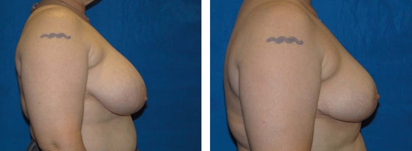 Breast Reduction Before & After Gallery - Patient 74827276 - Image 2