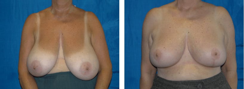 Breast Reduction Before & After Gallery - Patient 74827277 - Image 1