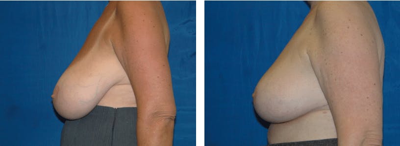 Breast Reduction Before & After Gallery - Patient 74827277 - Image 2