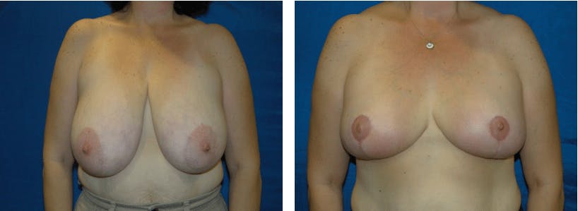 Breast Reduction Before & After Gallery - Patient 74827278 - Image 1