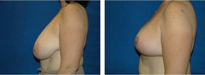 Breast Reduction Before & After Gallery - Patient 74827278 - Image 2