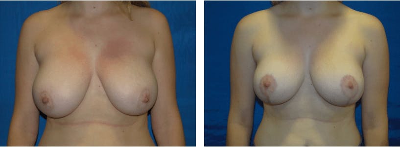 Breast Reduction Before & After Gallery - Patient 74827280 - Image 1