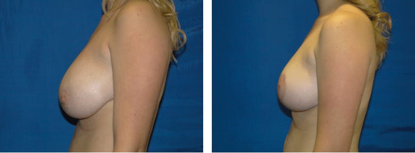 Breast Reduction Before & After Gallery - Patient 74827280 - Image 2