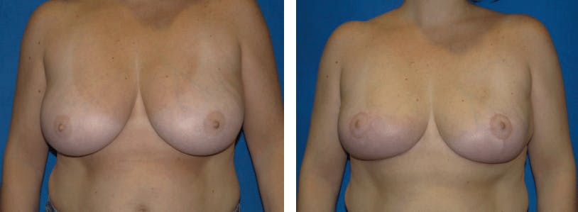 Breast Reduction Before & After Gallery - Patient 74827281 - Image 1