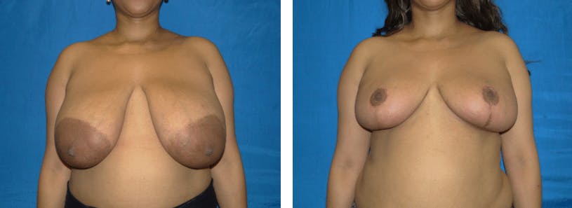 Breast Reduction Before & After Gallery - Patient 74827282 - Image 1